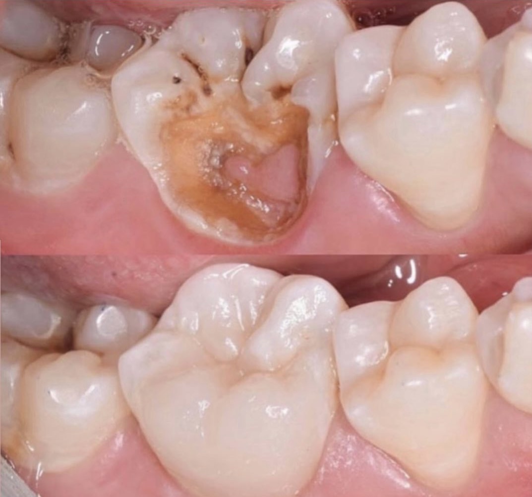 Resultado de tratamiento dental en Alfonzo Dental Group