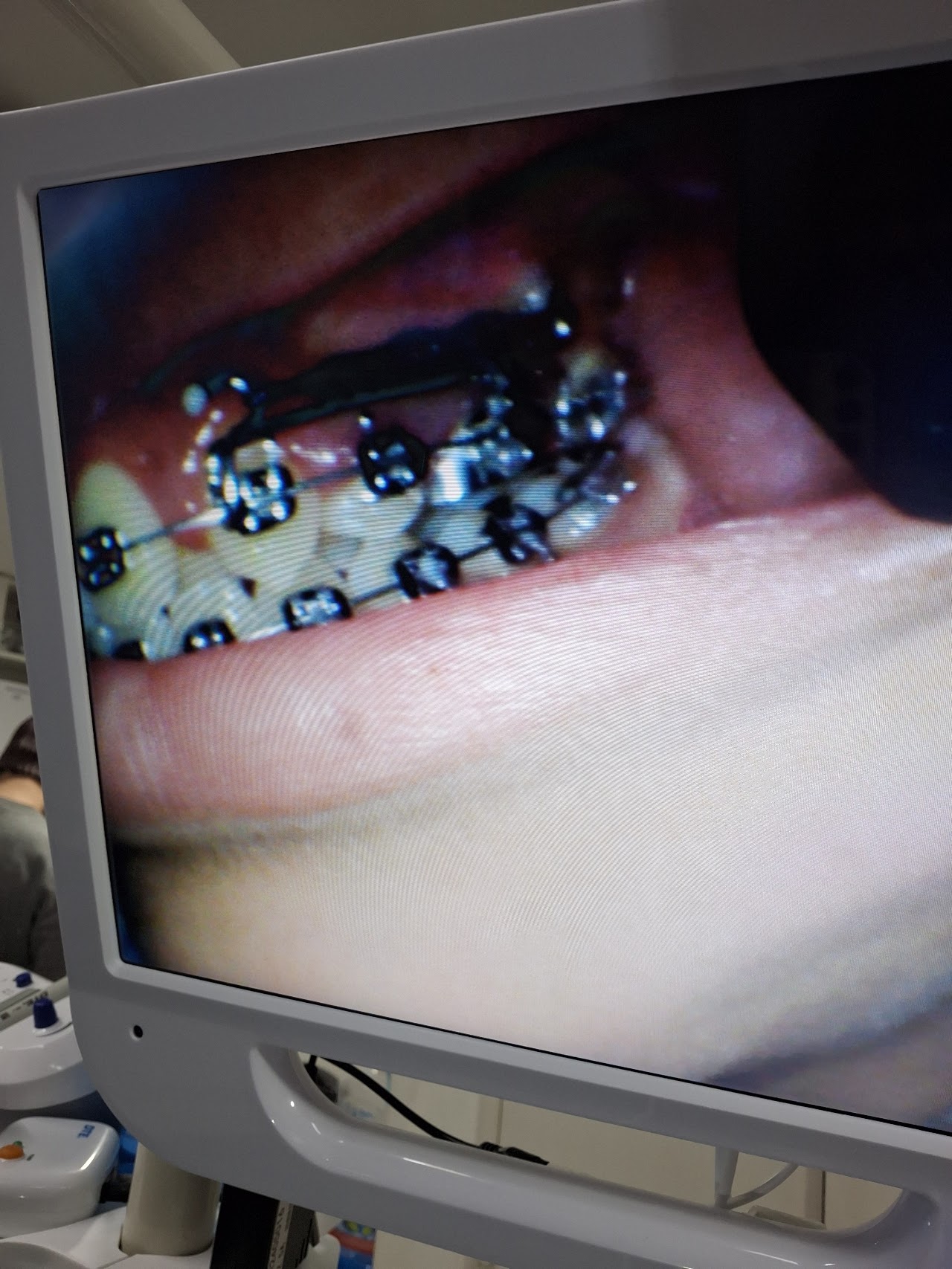 Tratamiento de ortodoncia en Alfonzo Dental Group